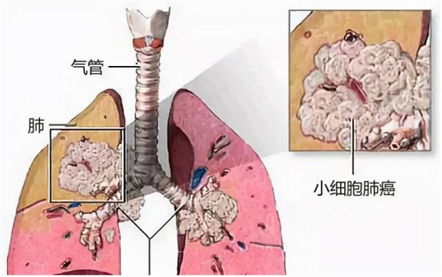 小细胞肺癌有多"恶"?