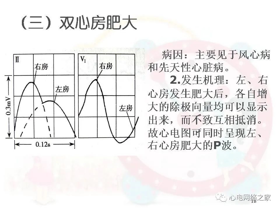 心房及心室肥大课件