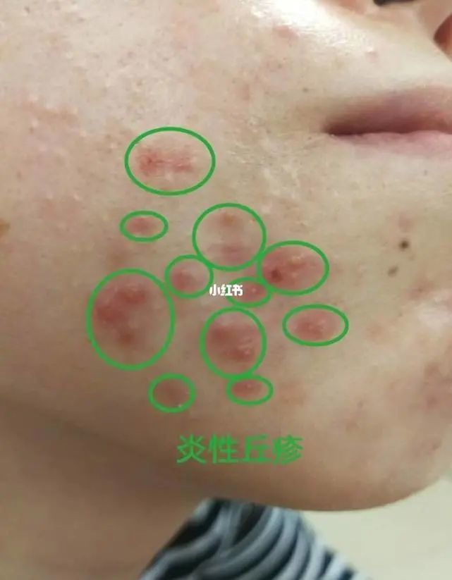 13岁女孩挤痘痘诱发败血症肺部形成了十几个空洞