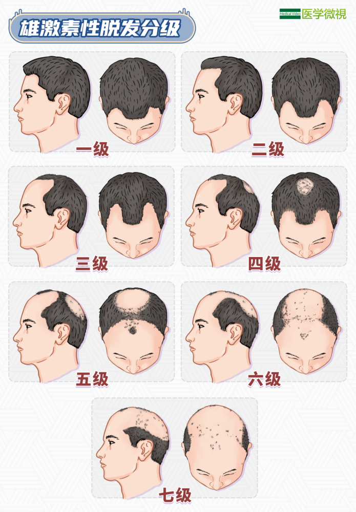 额部发际逐渐后退,或顶部头发逐渐稀疏,脱落,头发密度进行性减少,还可