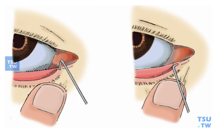 1岁以下的宝宝进行泪道探通手术时多用局麻,而1岁以上多为全麻.