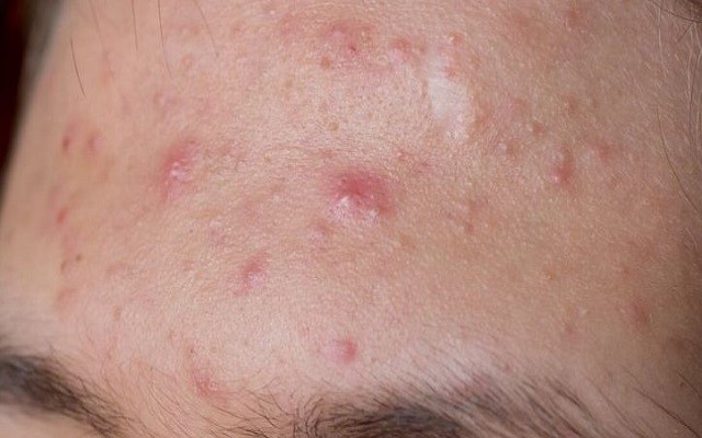 13岁女孩挤痘痘诱发败血症!脸上的痘痘千万别乱挤,你得这么干