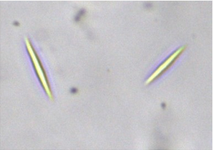 仍未找出虫卵,但发现了夏科-雷登结晶,镜下形态如图12所示:图11 患者