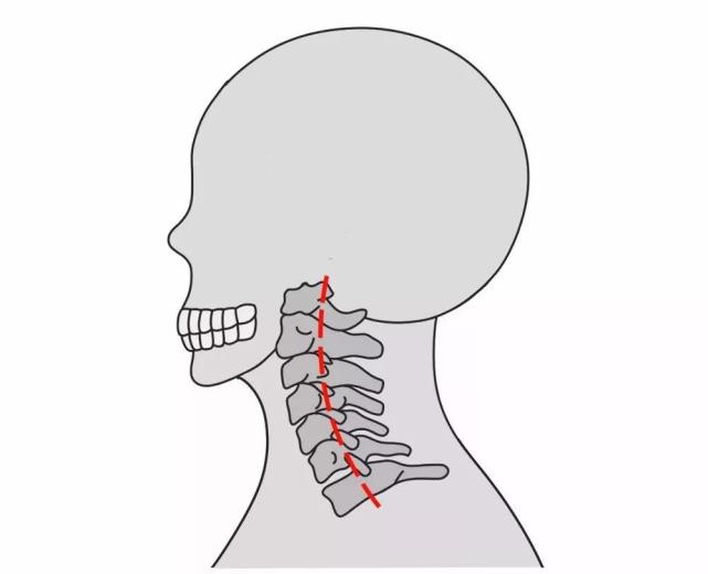 人體的頸椎有七節,正常情況下頸椎受後方肌肉韌帶的牽拉,會呈現前凸