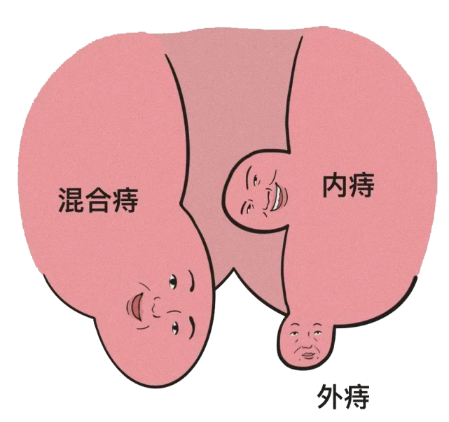 有痔疮的人,将经历什么?