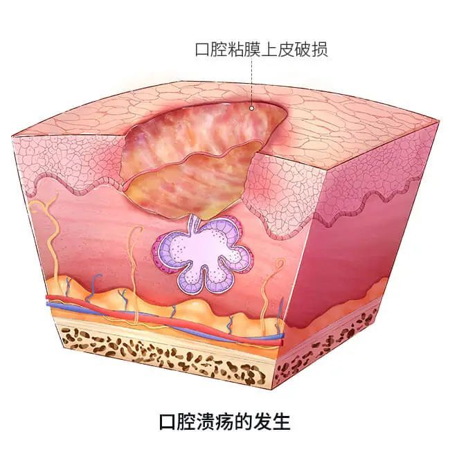 发生创伤性的口腔溃疡,或引起口腔溃疡复发