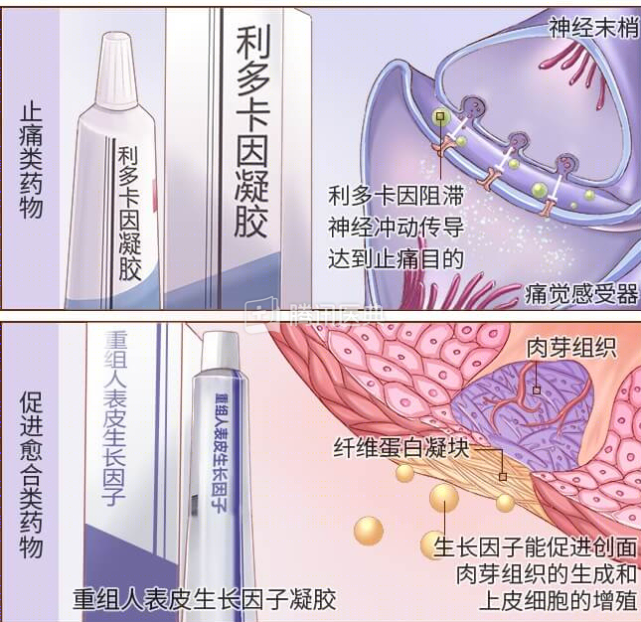 而重組人表皮生長因子凝膠,重組牛鹼性成纖維細胞生長因子凝膠,能促進