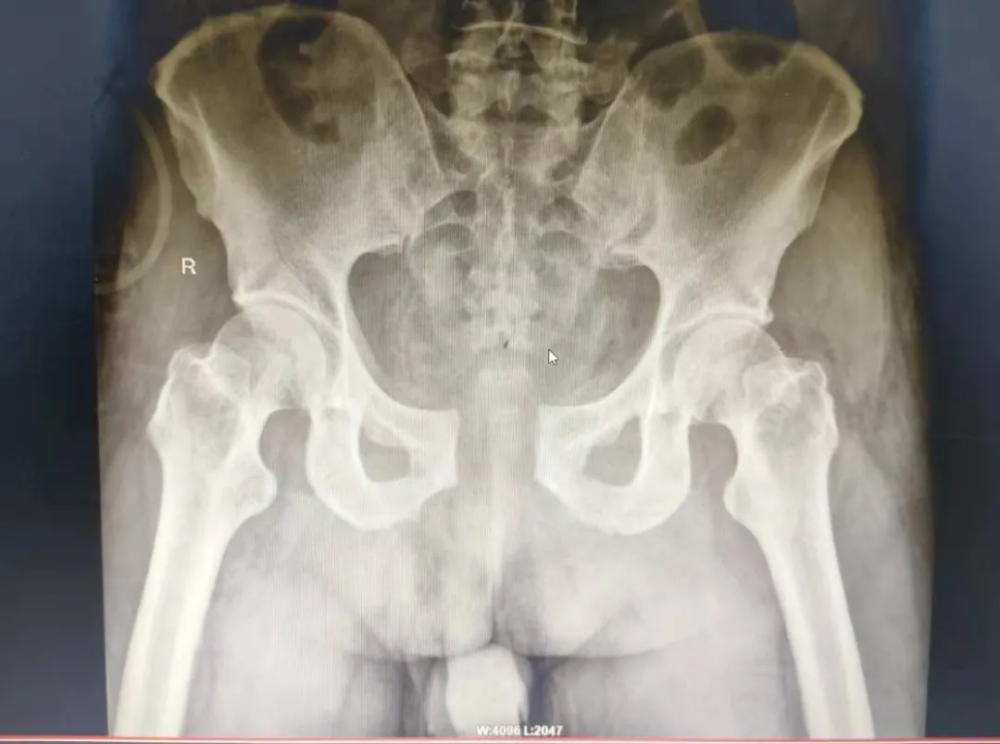 骨盆骨折怎么办 安乡县人民医院微创手术就能治好 腾讯新闻