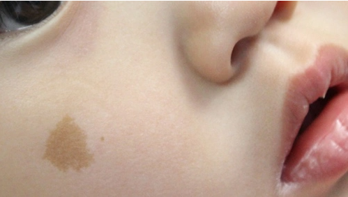 盘点7种常见的宝宝胎记,这2种不用管,剩下5种需要干预