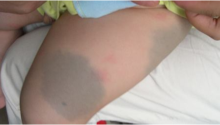 蒙古斑一般这种无色素痣不需要进行特别治疗.