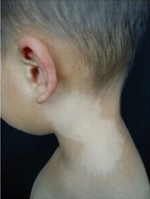 盘点7种常见的宝宝胎记,这2种不用管,剩下5种需要干预