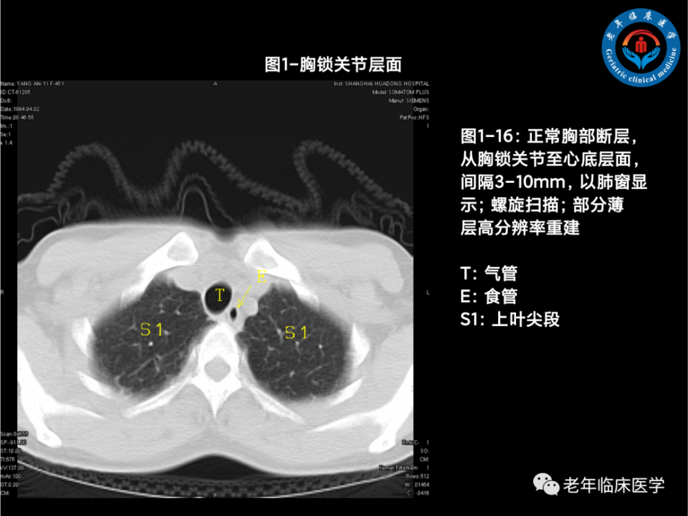 收藏經典肺段ct及病例分析