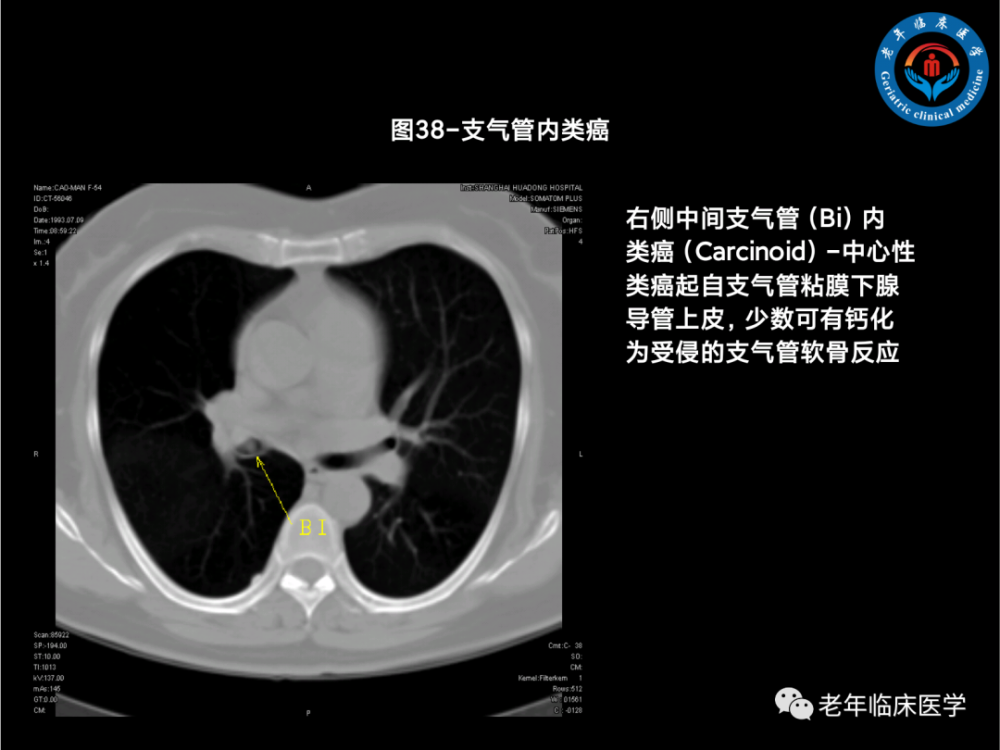 收藏經典肺段ct及病例分析