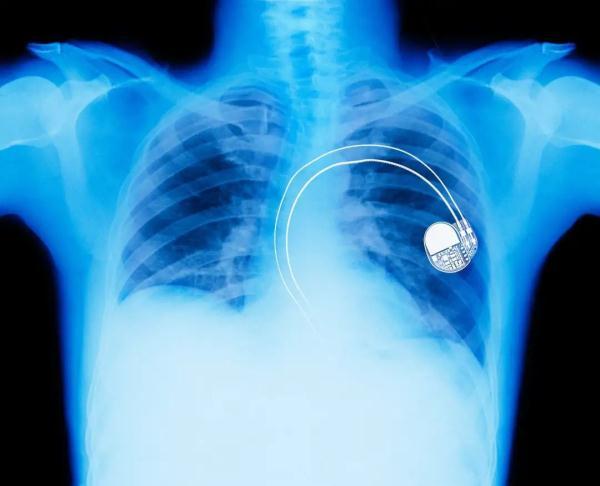 心脏起搏器的那些事你了解吗