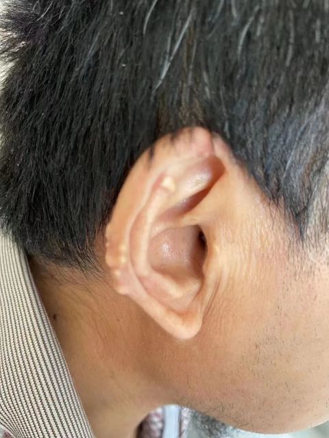 长在耳朵上的"痛风石"痛风不止是痛还可能导致尿毒症事实上,止痛治疗