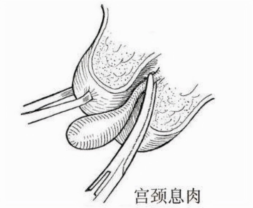 宮頸息肉生孩子不用擔心它自己會掉