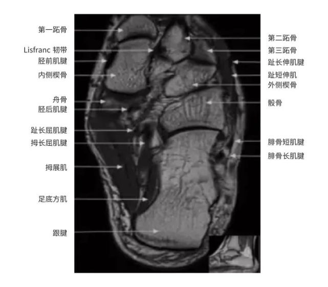 一文掌握|踝关节mri的断层解剖
