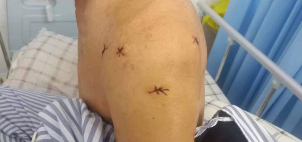 高水平医院建设小切口缓解半年肩膀痛骨科微创显成效