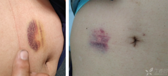 注射低分子肝素后惊现皮下血肿避免局部出血的8条建议