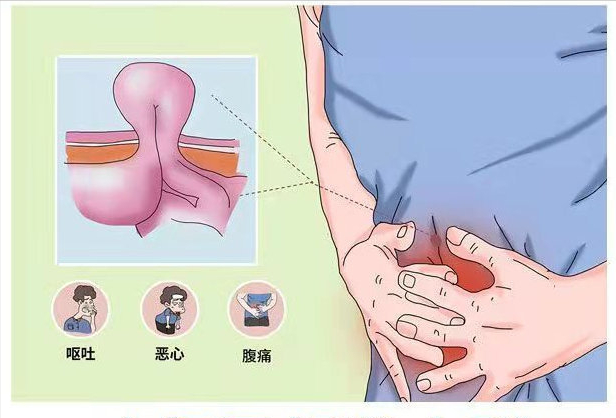 疝气带卡通图片