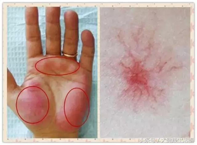 肝功能不全是什么原因