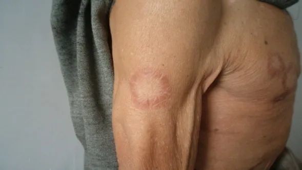 【卫生健康宣传日】世界麻风病日——关爱麻风患者,共创美好生活.