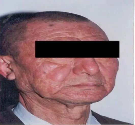 【卫生健康宣传日】世界麻风病日——关爱麻风患者,共创美好生活.