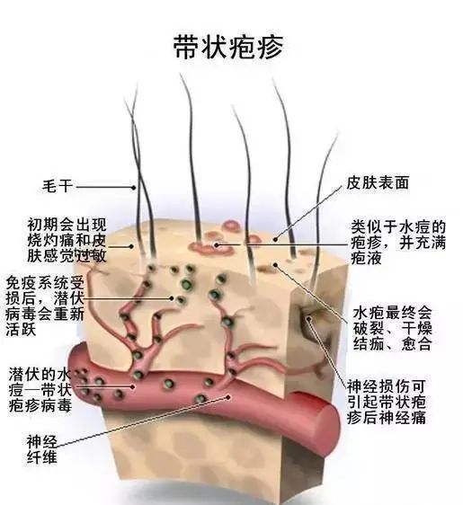 帶狀皰疹系由水痘-帶狀皰疹病毒引起,此病毒一般潛伏在脊髓後根神經元