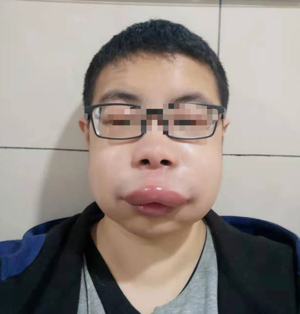 男子一发病就变成欧阳锋嘴肿得像香肠眼睛肿得像气球