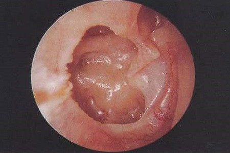 急性中耳炎照片图片