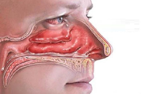 鼻息肉的复发率与其分型有关应全面检查对症治疗