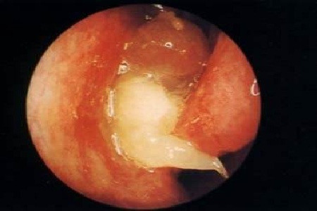 鼻息肉的复发率与其分型有关应全面检查对症治疗