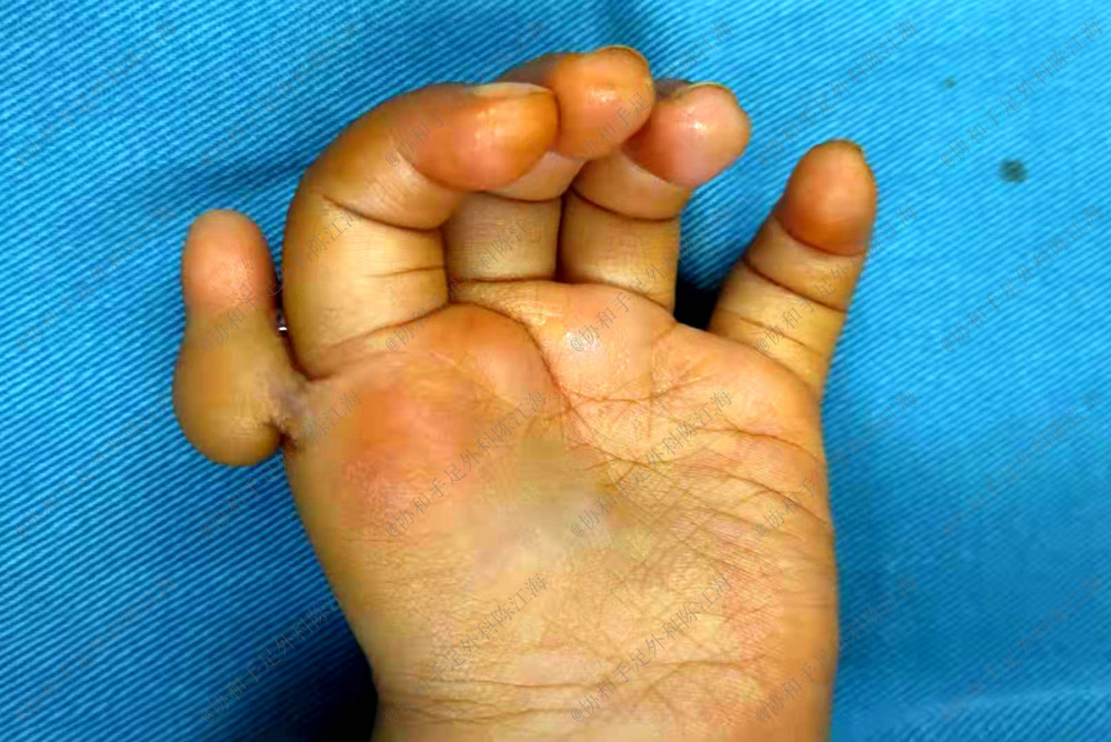 一岁的宝宝大拇指漂浮拇可以做再造手术吗