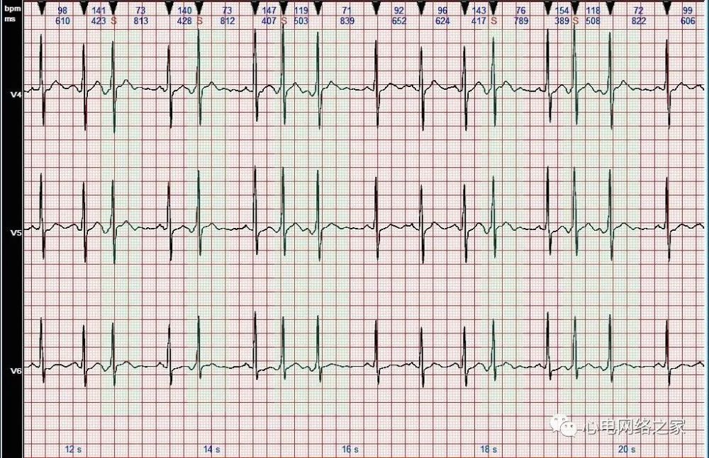心電圖圖例分析46頻發交界性早搏部分呈連發