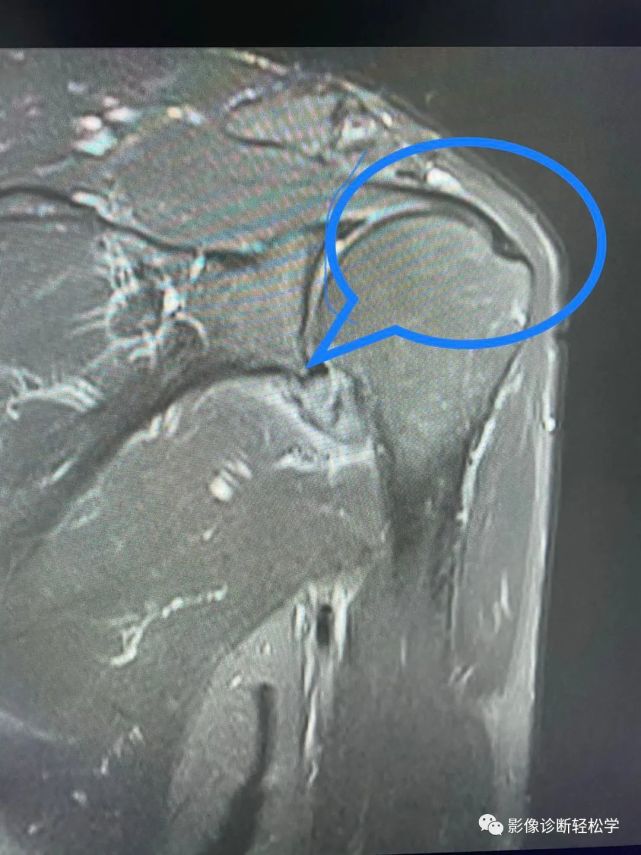 必須學會肩袖撕裂的mri診斷