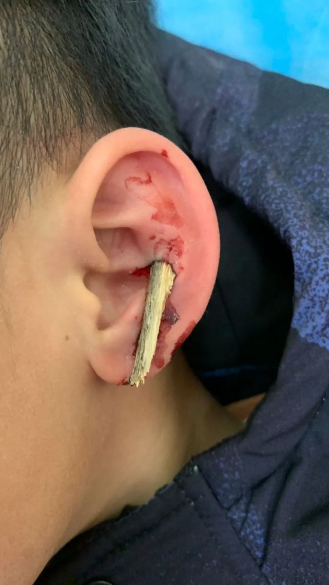 厦门五岁男孩公园玩耍耳朵被木桩叉扎伤儿童安全千万别放假