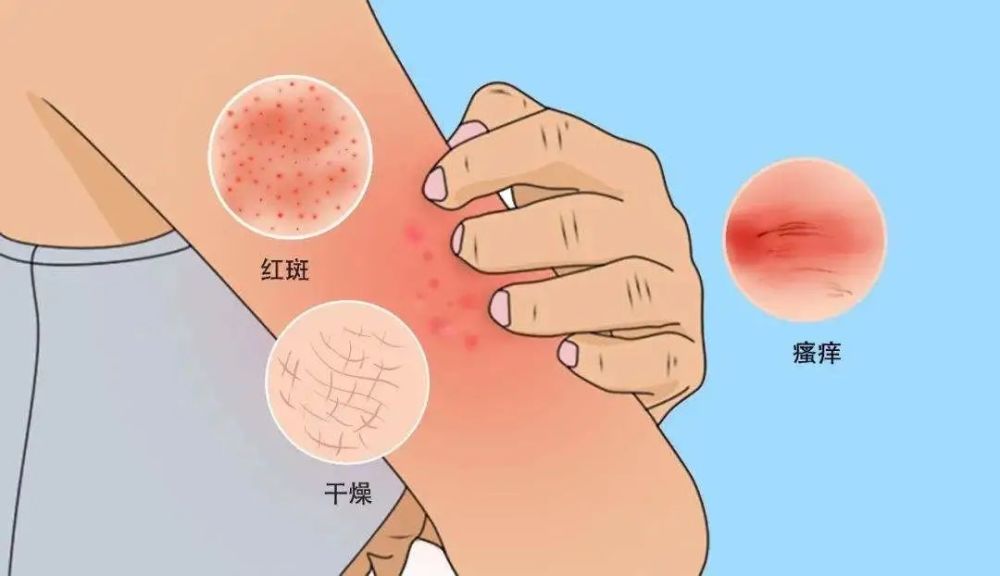 冬季皮肤持续瘙痒可能是特应性皮炎松江专家为您支招