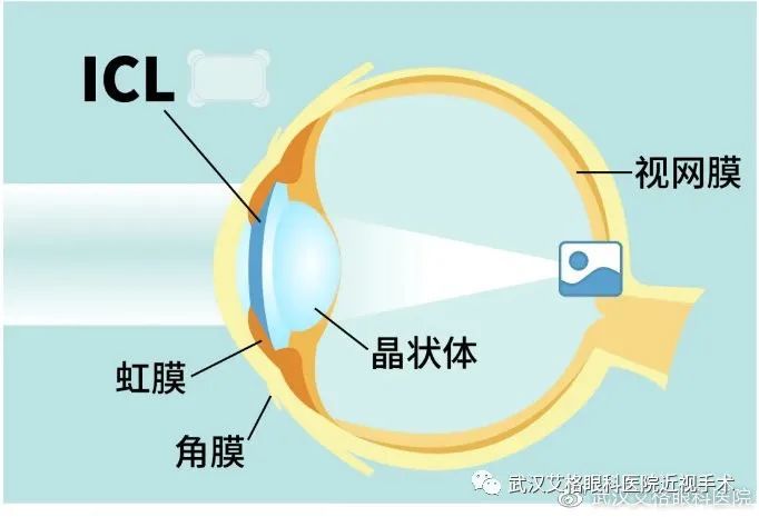 武漢眼睛有1000度近視能激光手術嗎醫生推薦