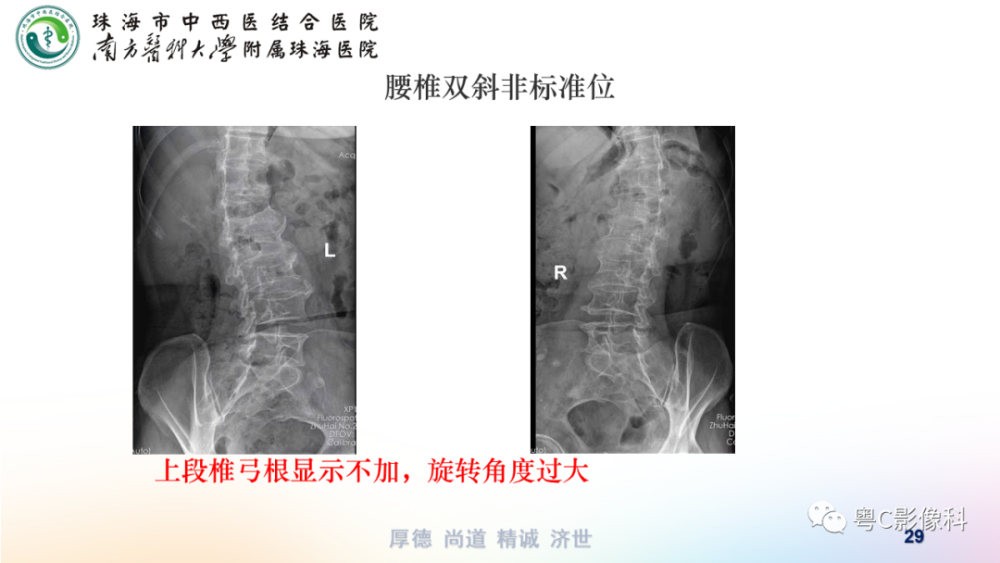 腰椎六位片攝影技術正側位雙斜位過伸過屈位