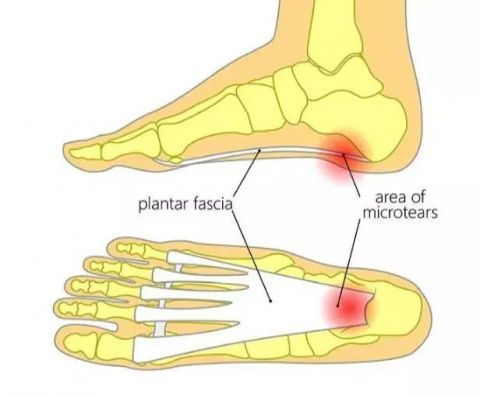 脚疼是怎么回事带你揭秘这几个不同部位疼痛的真相