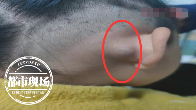 6岁女童耳后长包块不仅越来越大摸起来还很异常