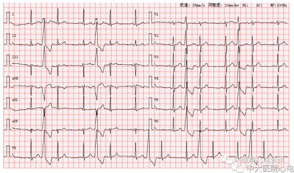 每日读图第1631期房扑伴三度房室传导阻滞室性逸搏心律