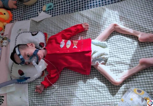 心疼,两岁男童患sma,全身只有眼睛手指能动,器官退化瘦成"骷髅架"