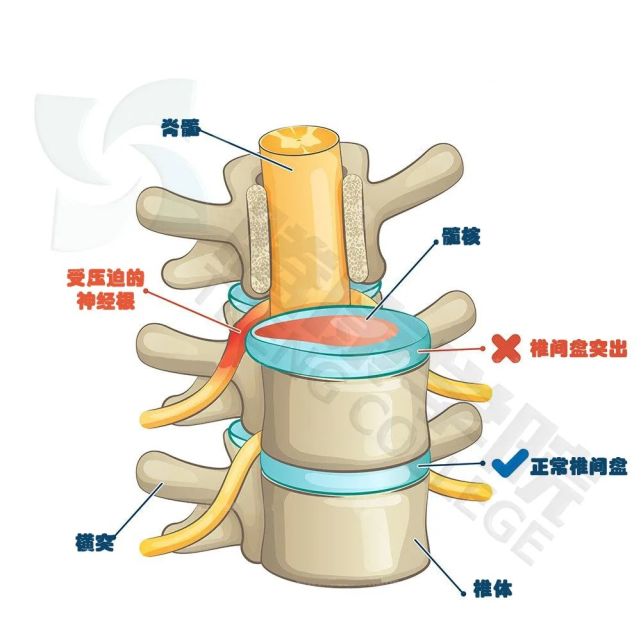 面對椎間盤突出,我們自己能做些什麼?