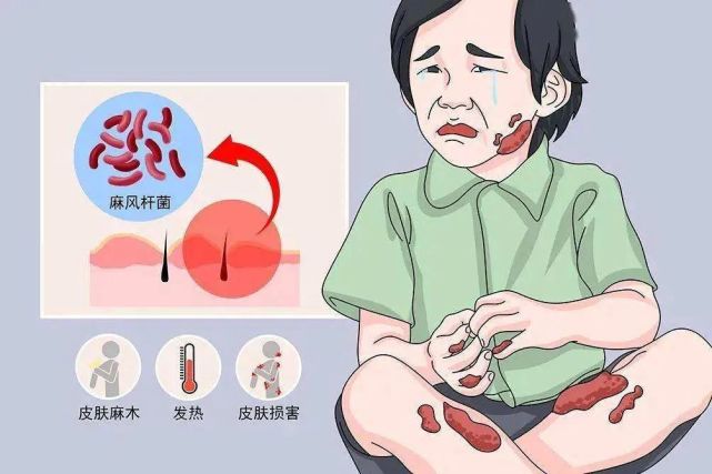 病情逐渐发展后可以出现兔眼,歪嘴,爪形手,垂足,足底溃疡等畸残