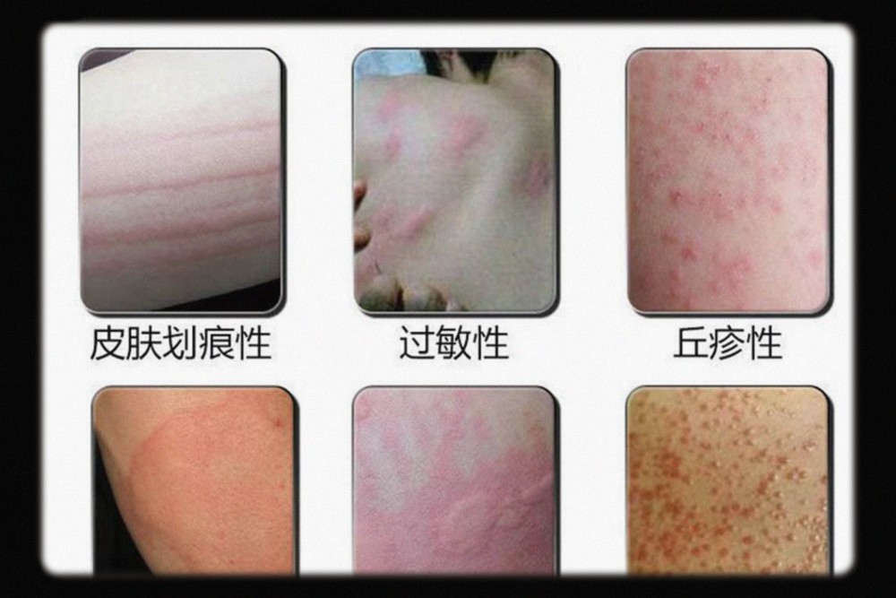 关于季节性过敏的那些事儿!家人一定要知道