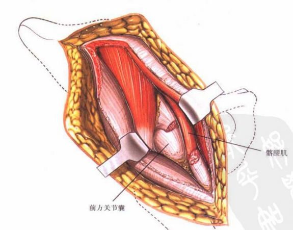 圖文詳解髖關節前側入路