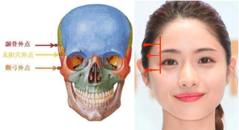 成为了面部的最宽处,改善这一点就需要增加太阳穴宽度和颞骨的宽度