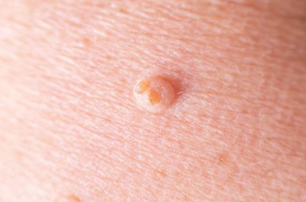 男人感染hpv身体3个地方会有提示不妨对照一下要警惕