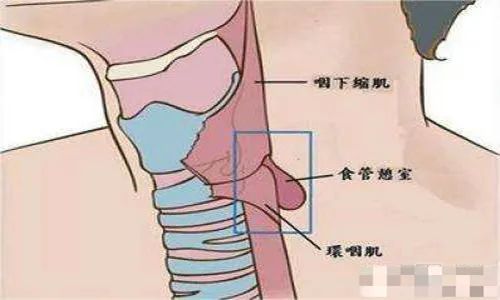 突破给食管轻松减负我院胸外二科成功开展巨大食管憩室切除术